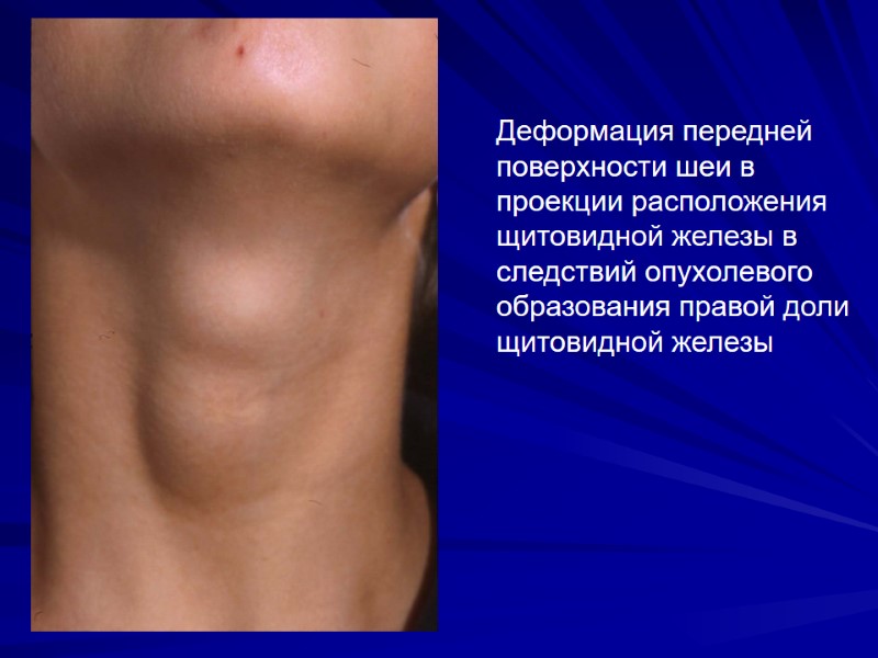 Деформация передней поверхности шеи в проекции расположения щитовидной железы в следствий опухолевого образования правой